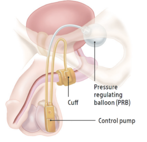 drawing of male anatomy with AMS 800 Urinary Control System.