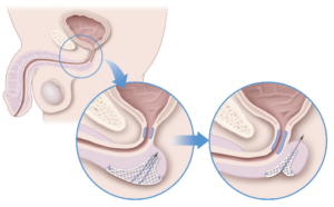 drawing of male anatomy with AdVance XP Male Sling