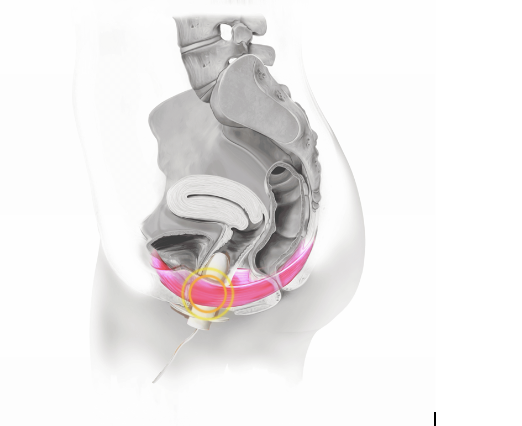 Pelvic Floor Image Flyte.