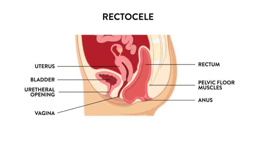 drawing of recotcele (rectal prolapse) with labels.