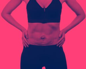 What Is Diastasis Recti And How Do I Fix It