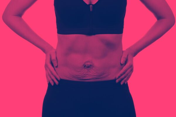 What Is Diastasis Recti And How Do I Fix It